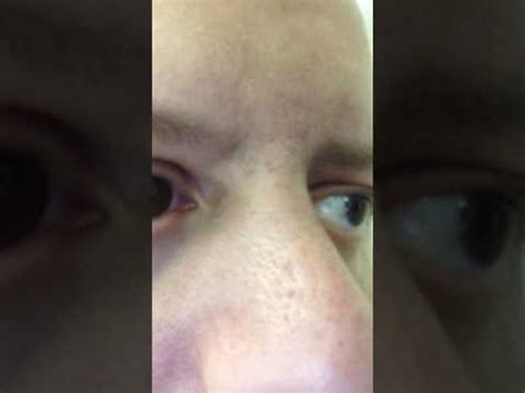 kuyanic twitch|spasms in bridge of nose.